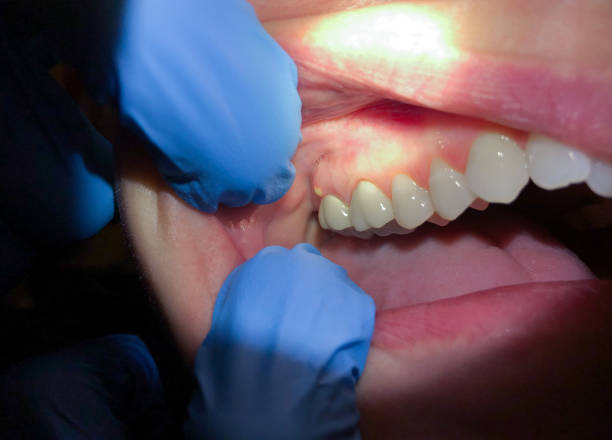 Best Tooth Infection Emergency Dentist  in Wilderness Rim, WA